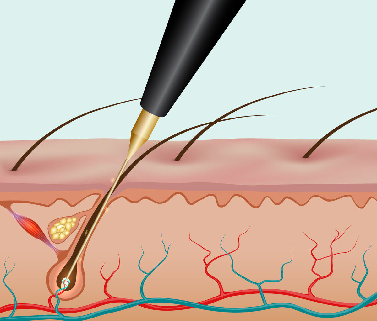 Hair electrolysis discount