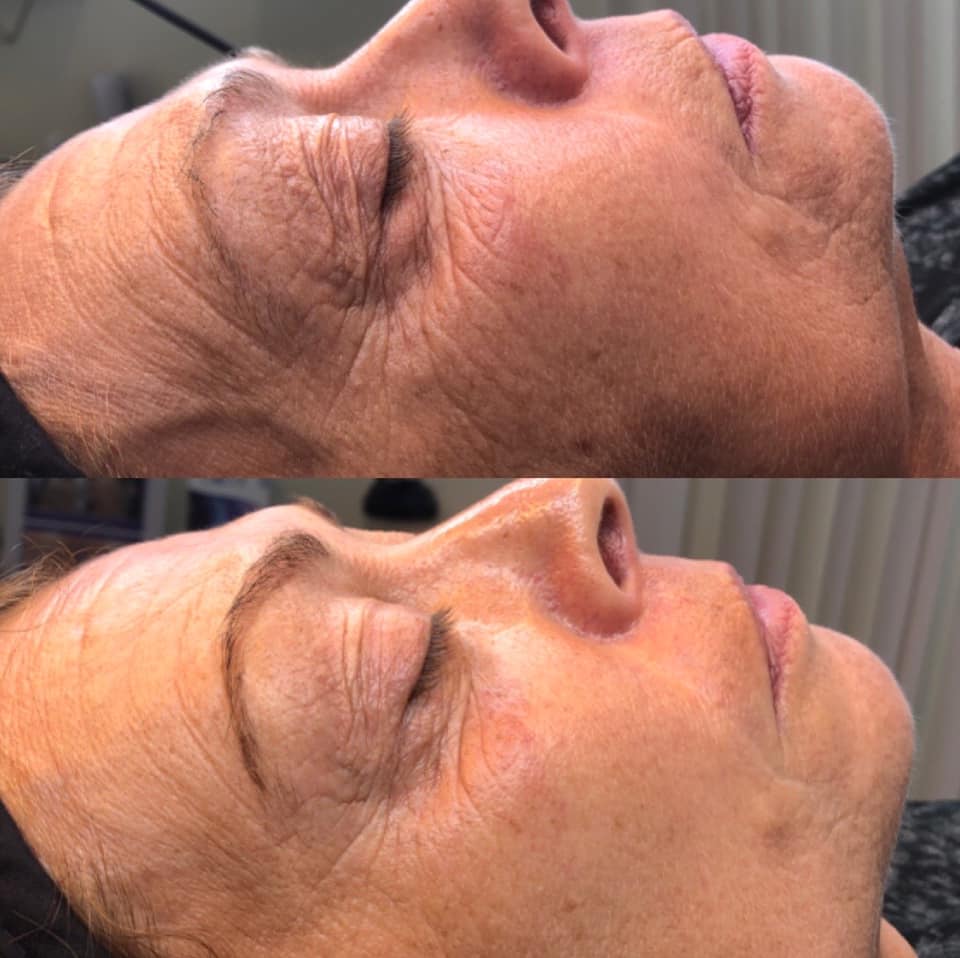 Procell Microchanneling MD & Dermaplaning Combo- Face (110 min)