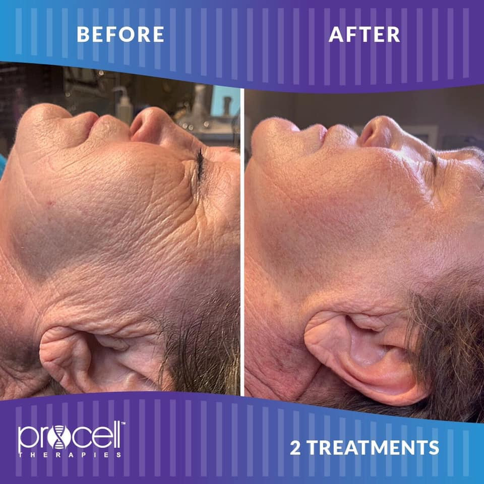Procell Microchanneling MD & Dermaplaning Combo- Face (110 min)