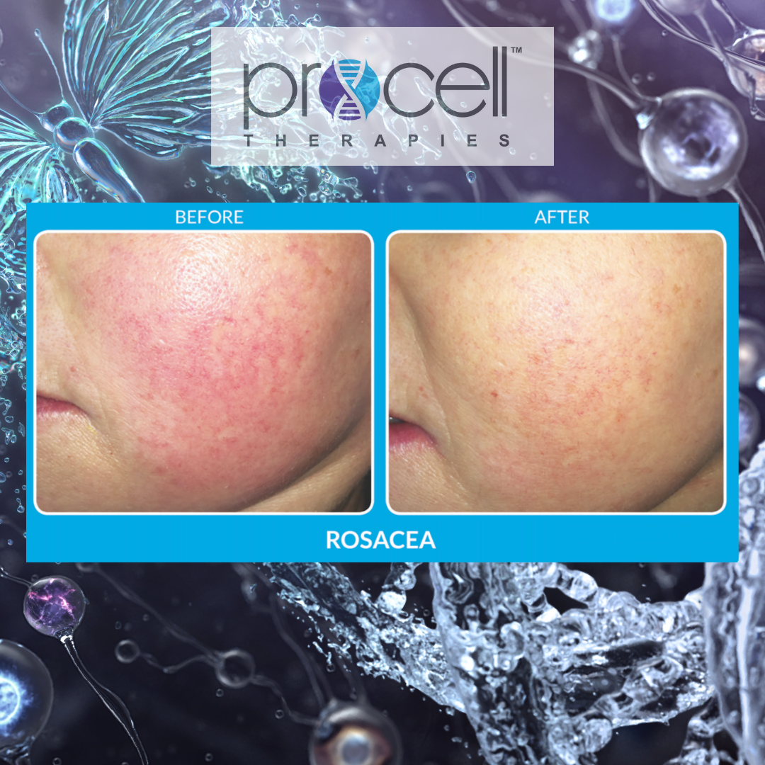 Procell Microchanneling MD & Dermaplaning Combo- Face (110 min)