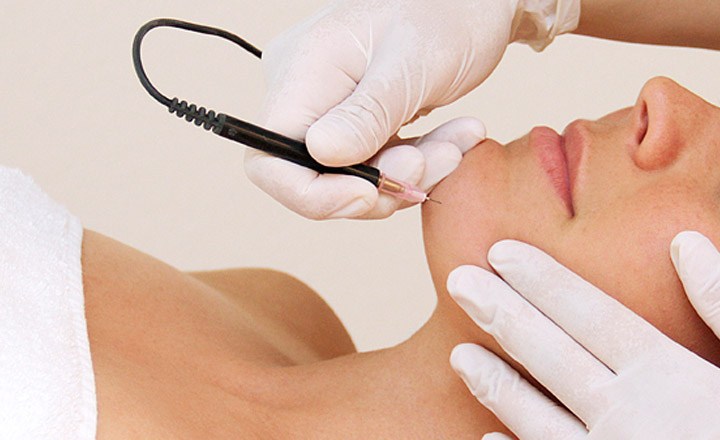 Electrolysis Consultation & Sample Treatment (45 min)